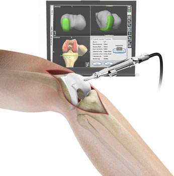 ConforMIS Custom Total Knee Replacement