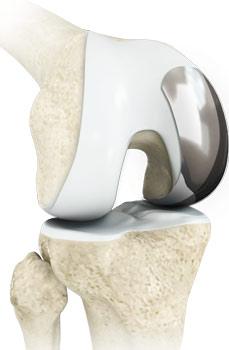 Uni condylar Knee Replacement