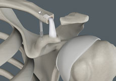 Acromioclavicular Joint Reconstruction