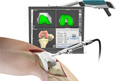 Computer Navigation for Total Knee Replacement