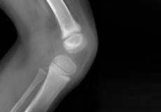 Congenital Absence of the Patella