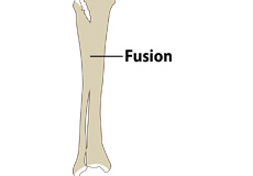 Congenital Knee Fusion