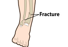 Congenital Pseudoarthrosis of the Tibia