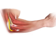 Ulnar Nerve Entrapment at the Elbow (Cubital Tunnel Syndrome)