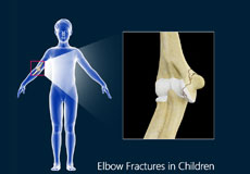 Elbow Fractures in Children