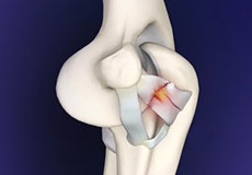 Elbow Ligament Reconstruction