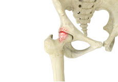 Femoro Acetabular Impingement (FAI)