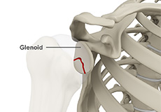 Glenoid Fracture