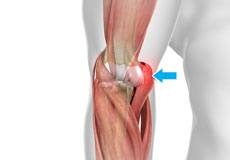 Golfer's Elbow