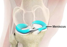 Meniscus Tear