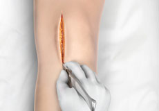 Minimally Invasive Knee Joint Replacement
