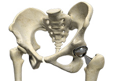 Outpatient Hip Replacement