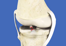 Pediatric ACL Tears