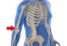 Pediatric Supracondylar Fractures