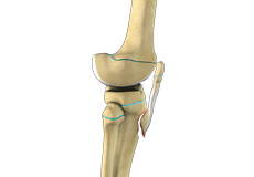 Pediatric Tibial Tubercle Fractures