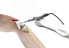 Mako Robotic-Arm Assisted Partial Knee Replacement