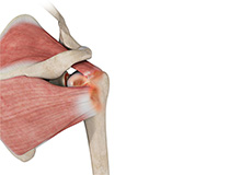 Rotator Cuff Arthropathy