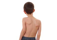 Scoliosis in Children