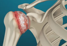 Shoulder Arthritis