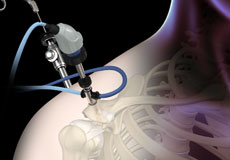 Shoulder Arthroscopy