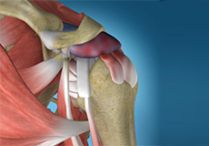 Shoulder Impingement