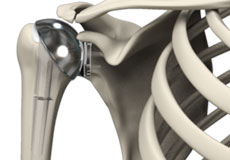 Shoulder Joint Replacement