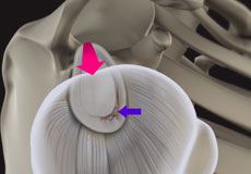 Shoulder Labrum Tear