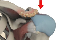 Subacromial Decompression