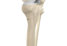 Tibia Fractures in Children