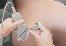 Ultrasound Guided Shoulder Injections