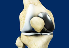 Uni Condylar Knee Replacement